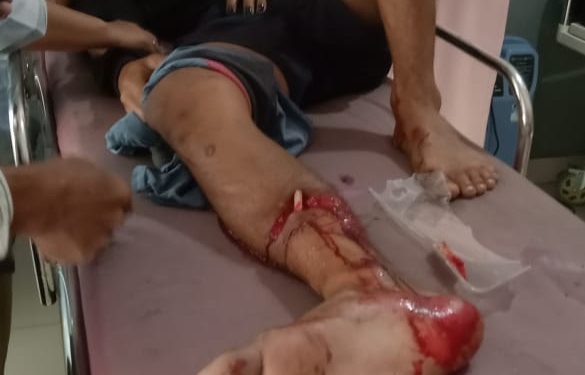 Korban Laka di Gelumbang Alami Patah Kaki