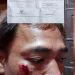 Kipri Herdiansya Biro Koran Pontensi Sekaligus Bendahara DPD IWO I Kota Pagar Alam Korban Penganiayaan Kontraktor Lokal “RL”